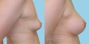 Patient 1c Breast Augmentation Before and After