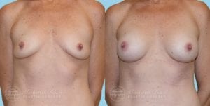 Patient 3a Breast Augmentation Before and After