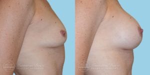 Patient 3c Breast Augmentation Before and After
