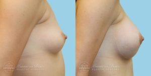 Patient 4c Breast Augmentation Before and After