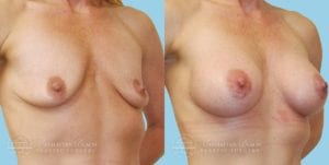 Patient 6b Breast Augmentation Before and After