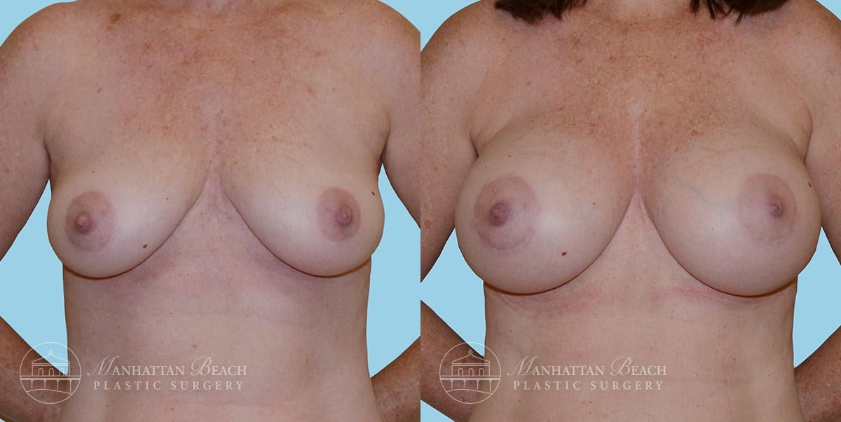 Patient 10a Breast Augmentation Before and After