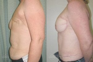Patient 4a Before and After Breast Reconstruction