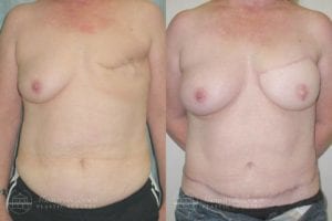 Patient 4e Before and After Breast Reconstruction