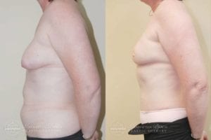 Patient 6a Before and After Breast Reconstruction