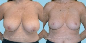 Patient 1a Breast Reduction Before and After