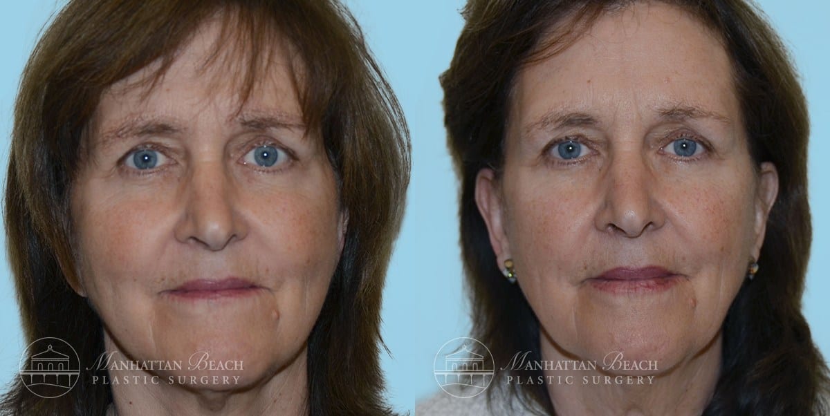 Patient 1a Before and After Facelift