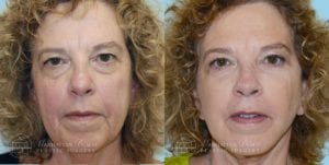 Patient 2a Before and After Facelift