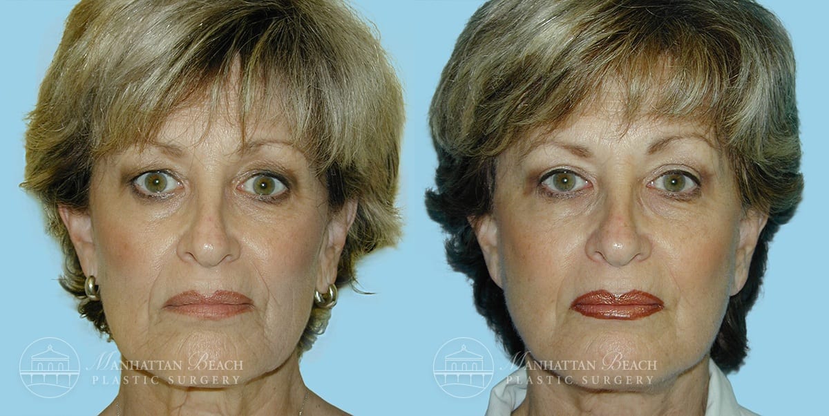 Patient 3a Before and After Facelift