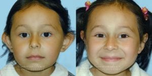 Patient 1b Before and After Otoplasty