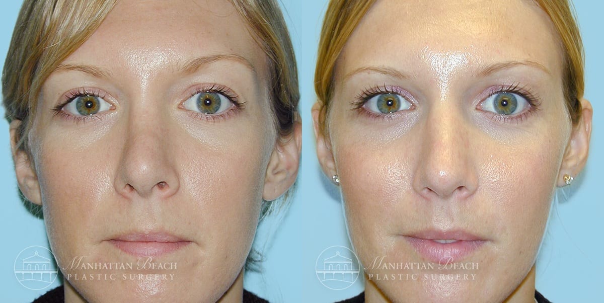 Patient 2a Before and After Rhinoplasty
