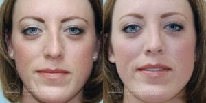 Patient 3a Before and After Rhinoplasty
