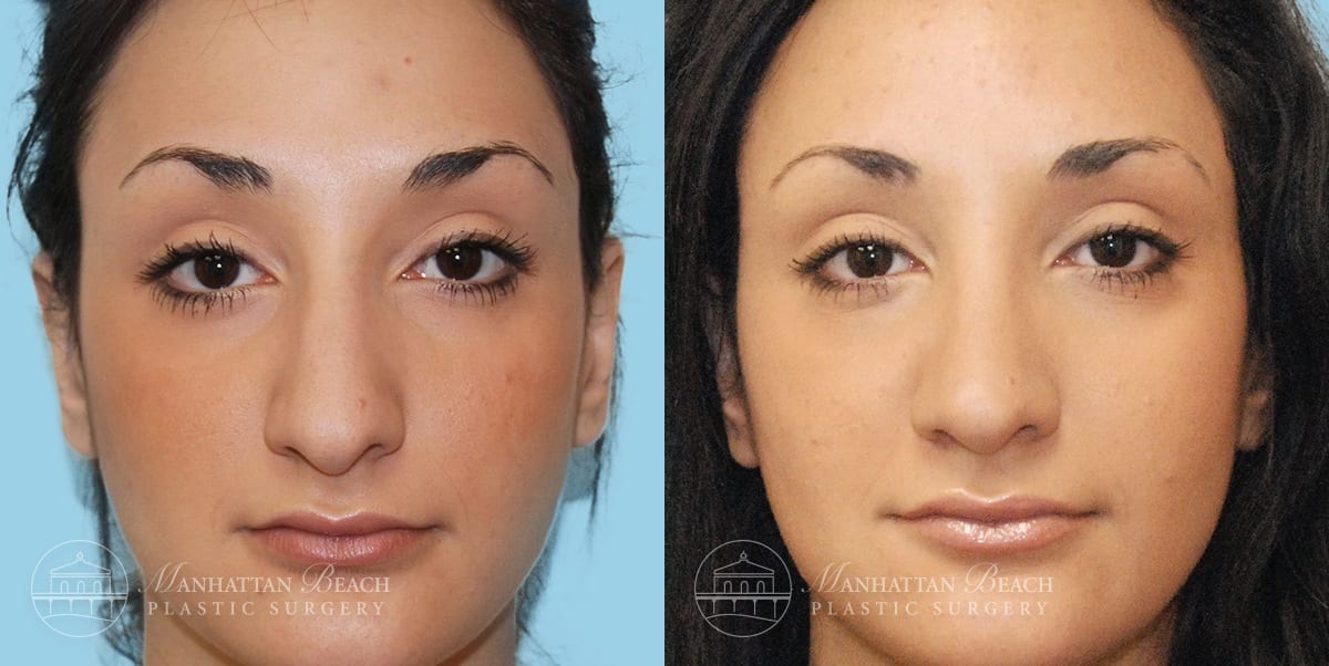 Patient 4a Before and After Rhinoplasty