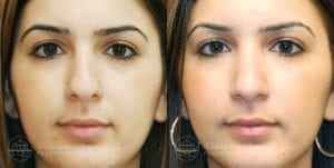 Patient 5a Before and After Rhinoplasty