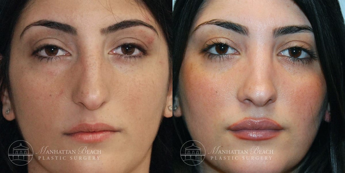 Patient 6a Before and After Rhinoplasty