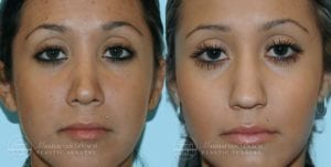 Patient 7a Before and After Rhinoplasty