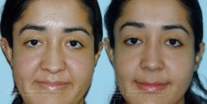 Patient 8a Before and After Rhinoplasty