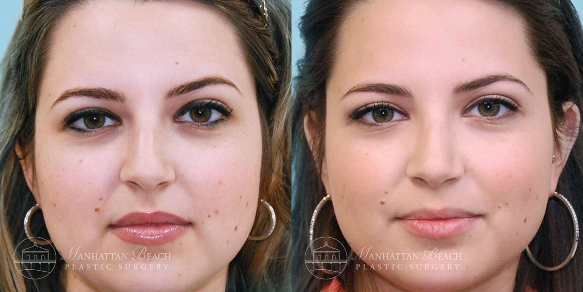 Patient 9a Before and After Rhinoplasty