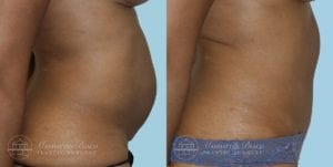 Patient 2a Tummy Tuck Before and After