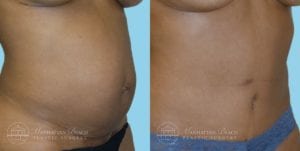 Patient 2b Tummy Tuck Before and After