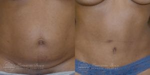 Patient 2c Tummy Tuck Before and After